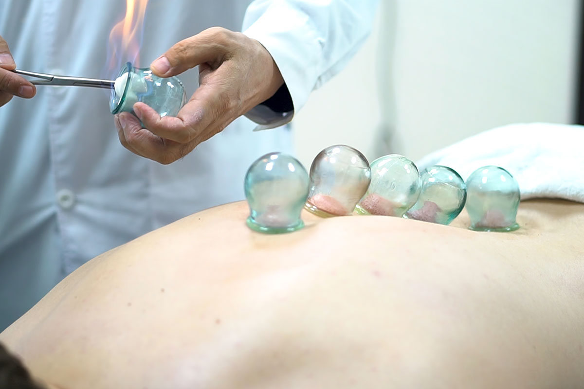 fire cupping therapy